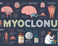 Causes, Symptoms and Treatment of Myoclonus!