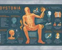 What are the Symptoms, Causes and Treatments of Dystonia